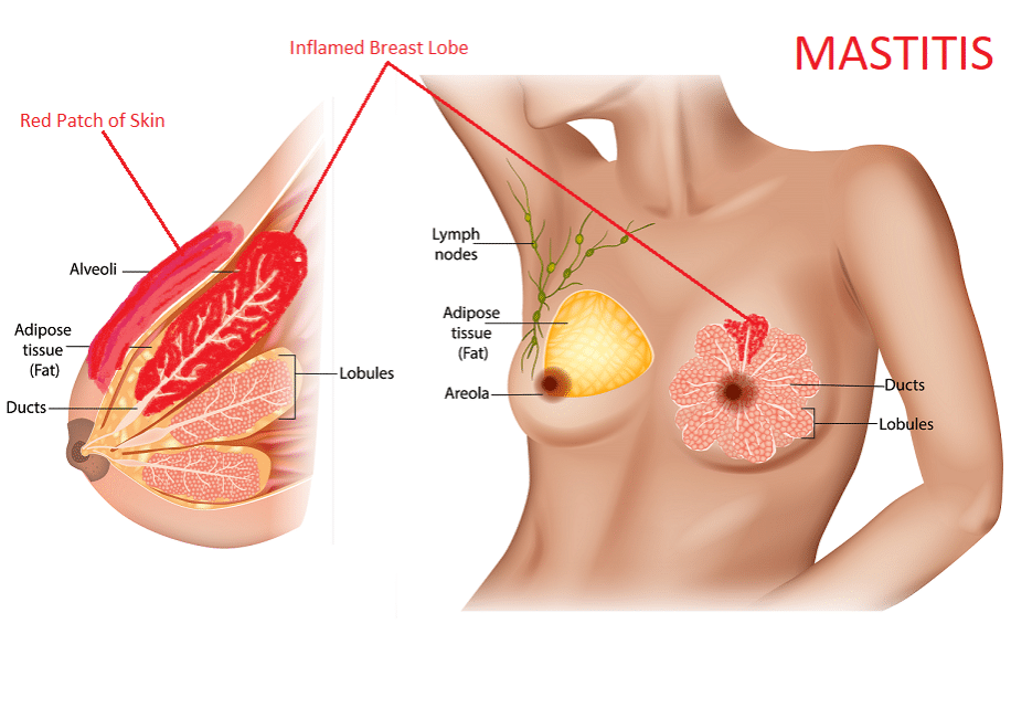 Mastitis Diagram